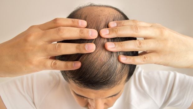 Get Rid of Male Pattern Baldness